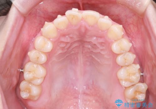 【オープンバイト】前歯のがたがたをなおしたい。の治療中