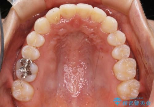 【非抜歯】下の前歯が1本少ない場合の矯正治療の治療後