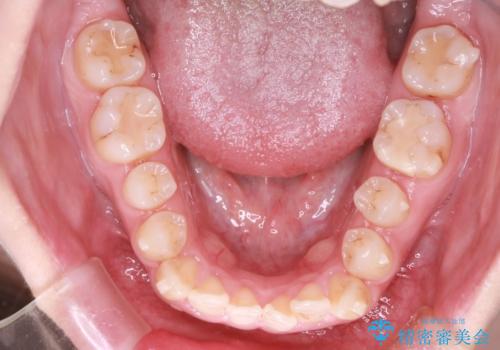 【オープンバイト】前歯のがたがたをなおしたい。の治療中