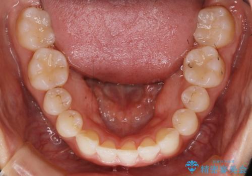 【非抜歯】下の前歯が1本少ない場合の矯正治療の治療後