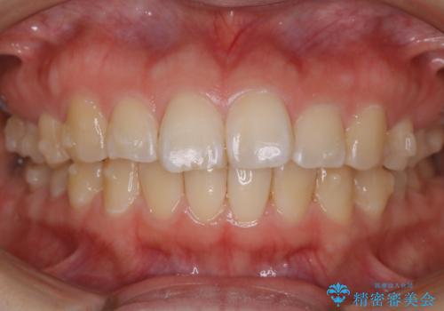 【非抜歯】ガタつきと歯軸を正して長持ちする歯への治療中