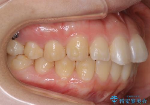 【非抜歯】ガタつきと歯軸を正して長持ちする歯への治療中