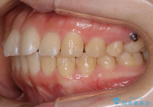 【非抜歯】ガタつきと歯軸を正して長持ちする歯への治療中