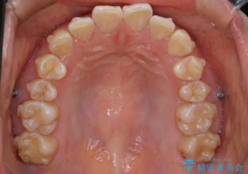 【非抜歯】ガタつきと歯軸を正して長持ちする歯への治療中