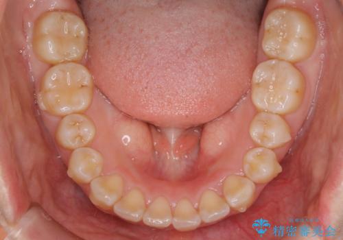 【非抜歯】ガタつきと歯軸を正して長持ちする歯への治療中