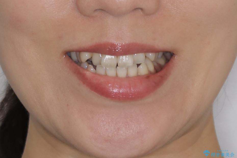 【非抜歯】20代女性　歯のガタつきと噛み合わせの治療の治療前（顔貌）