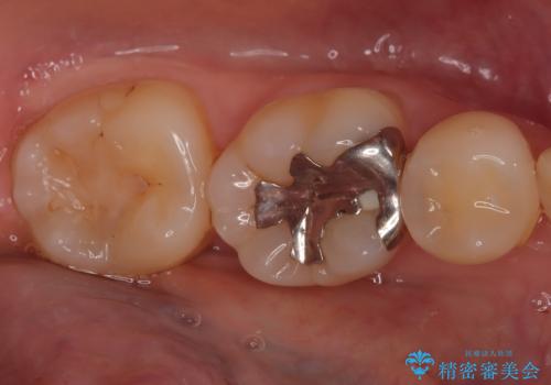 【ハイブリッドインレー】銀歯を白くしたい!の治療前