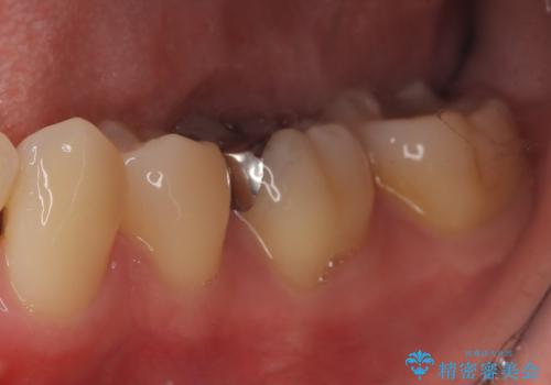 【ハイブリッドインレー】銀歯を白くしたい!の治療前