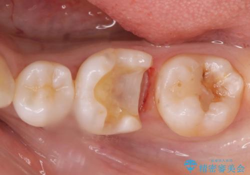 メタルの詰め物が取れたの治療中