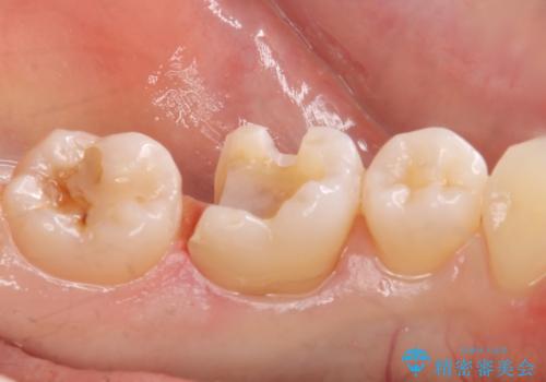メタルの詰め物が取れたの治療中