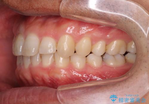 2級ディープバイト 遠心移動を伴うマウスピース矯正の治療後