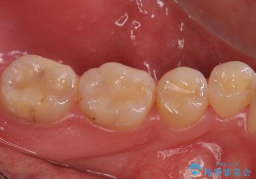 奥歯がしみる 神経を温存する治療の治療前