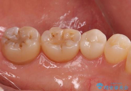 産後の虫歯治療 セラミッククラウンでの治療の治療前