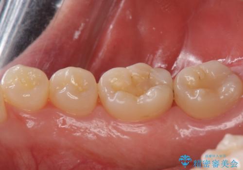 見た目にはわかりにくい奥歯の虫歯 セラミックインレーでの治療の治療前