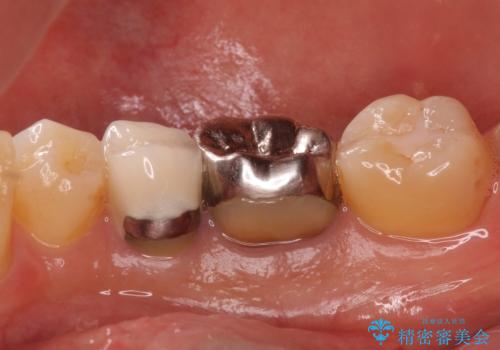 目立つ銀歯を白くしたい ジルコニアクラウンでの修復の治療前