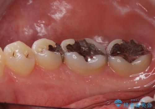 銀歯を白くしたい　セラミックインレーでの治療の治療前