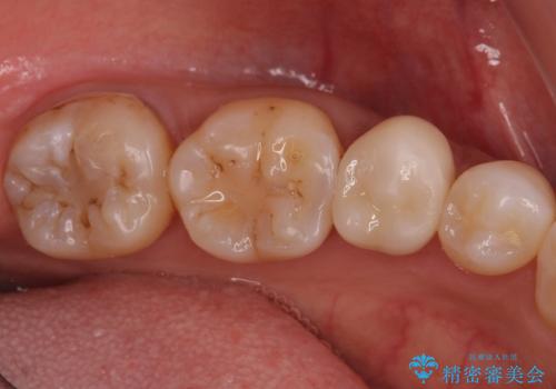 産後の虫歯治療 セラミッククラウンでの治療の治療前