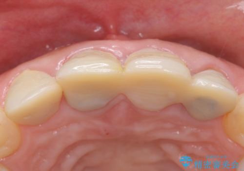 自然な前歯にしたい ジルコニアクラウンでの修復の治療前