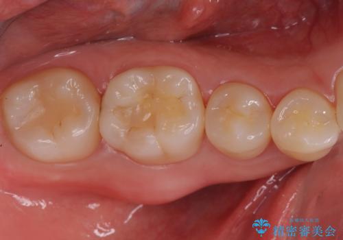 見た目にはわかりにくい奥歯の虫歯　セラミックインレーでの治療の治療前