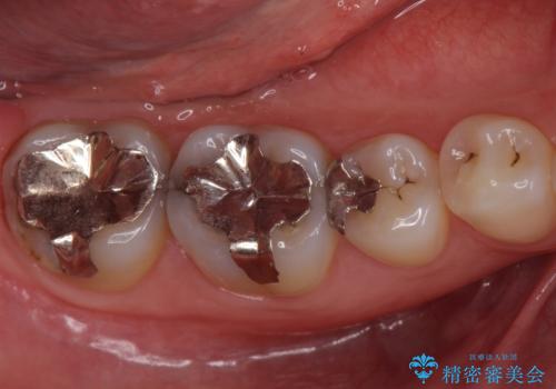 銀歯を白くしたい セラミックインレーでの治療