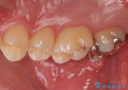 銀歯をなくしたい ジルコニアクラウンでの修復の治療前