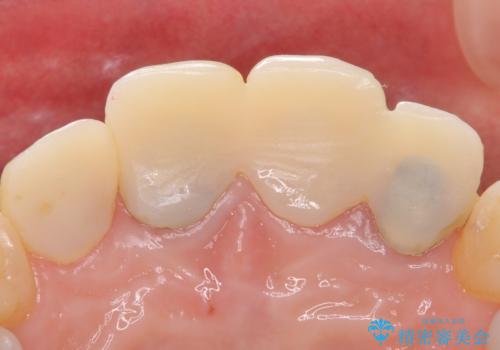 自然な前歯にしたい ジルコニアクラウンでの修復の治療前