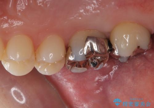 銀歯を白くしたいの治療前