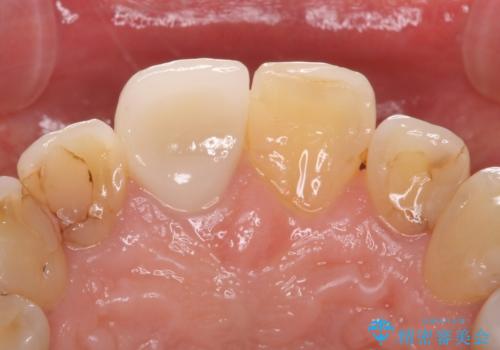 前歯を綺麗にしたい。 ジルコニアクラウンでの修復の治療前