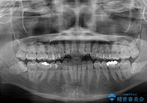 前歯のクロスバイト インビザラインによる矯正治療の治療前