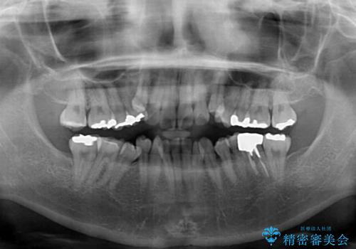 インビザラインが続けられない 装置変更して抜歯矯正の治療前