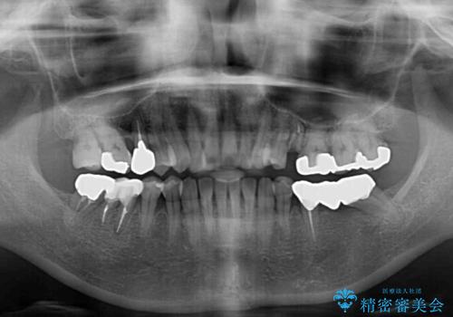 正中のズレと飛び出した前歯を改善 メタルブラケットでの抜歯矯正の治療前