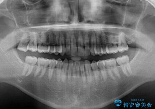 【モニター】楽して治したい メタルブラケットによる矯正治療の治療前