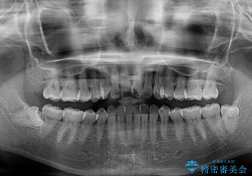 手間をかけずに治したい 短期間のワイヤー矯正の治療前