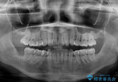 【モニター】舌のトレーニングを行いながら後戻りの再矯正の治療前