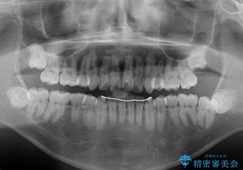 【モニター】後戻りで飛び出してきた前歯 ワイヤー装置での再矯正の治療前