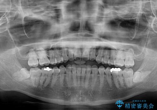 前歯のクロスバイト インビザラインによる矯正治療の治療後