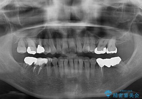 正中のズレと飛び出した前歯を改善　メタルブラケットでの抜歯矯正の治療後