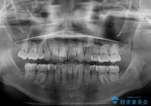【モニター】舌のトレーニングを行いながら後戻りの再矯正の治療後