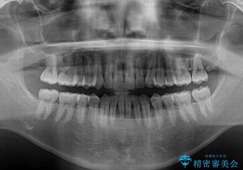 【モニター】楽して治したい メタルブラケットによる矯正治療の治療後