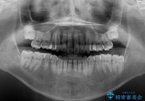 【モニター】後戻りで飛び出してきた前歯 ワイヤー装置での再矯正の治療後