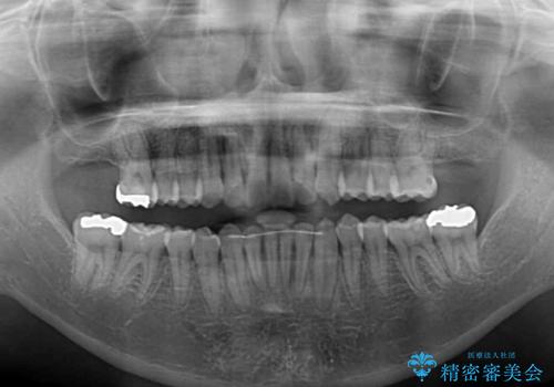 【モニター】前歯のデコボコをインビザラインで改善の治療後