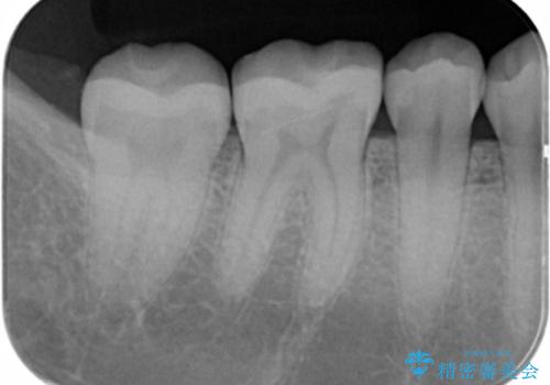 銀歯を白くしたい　セラミックインレーでの治療の治療後