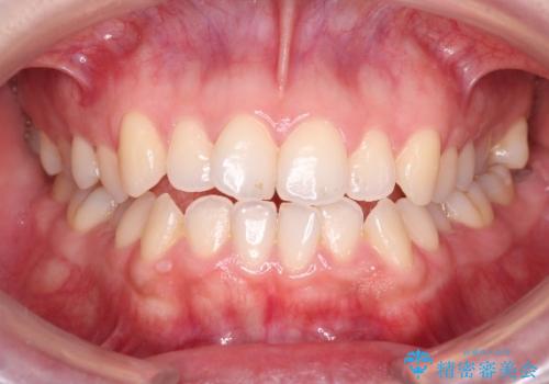 【オープンバイト】前歯のがたがたをなおしたい。の治療前