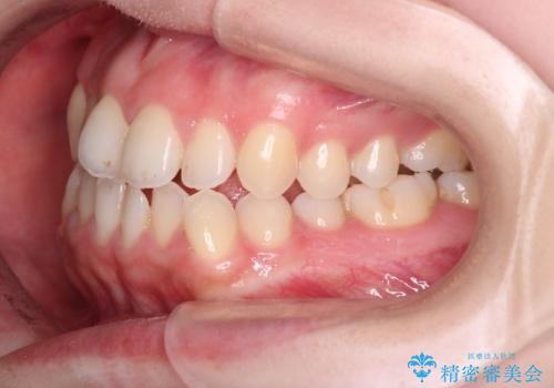 【オープンバイト】前歯のがたがたをなおしたい。の治療前