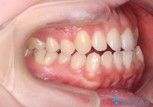 【オープンバイト】前歯のがたがたをなおしたい。の治療前