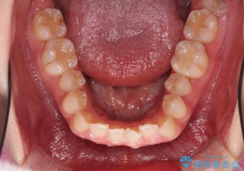 【オープンバイト】前歯のがたがたをなおしたい。の治療前