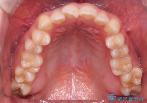 【オープンバイト】前歯のがたがたをなおしたい。の治療前