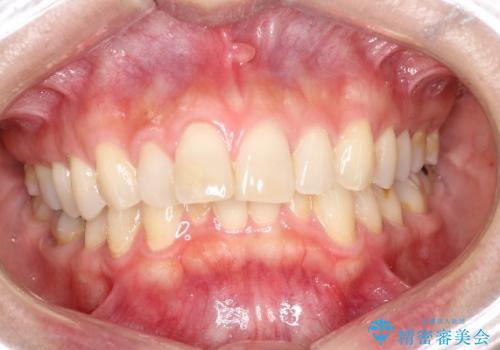 【インビザライン】前歯の凸凹を治したいの治療前