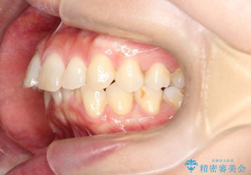【インビザライン】前歯の凸凹を治したいの治療前