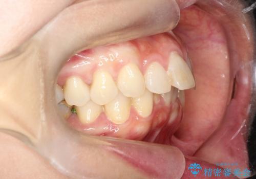 【インビザライン】前歯の凸凹を治したいの治療前